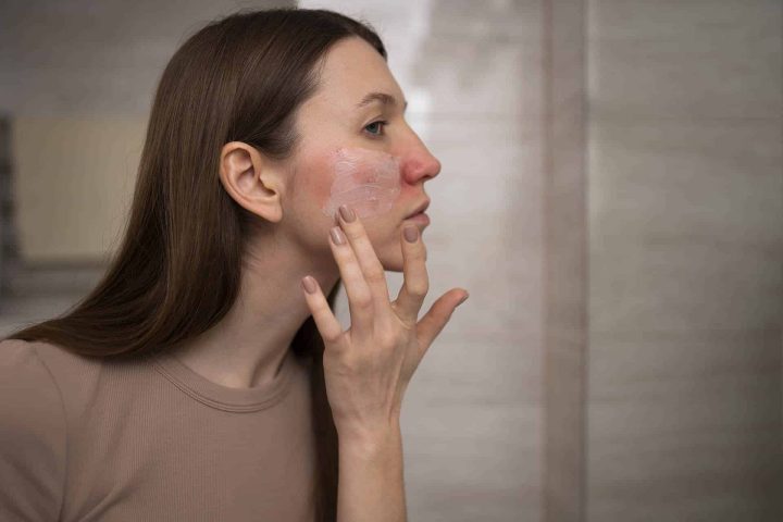 rosacea rosacea