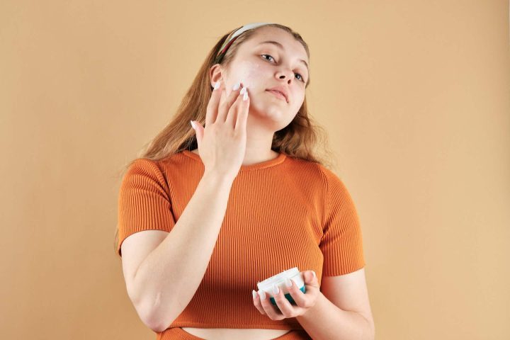 Melasma Melasma