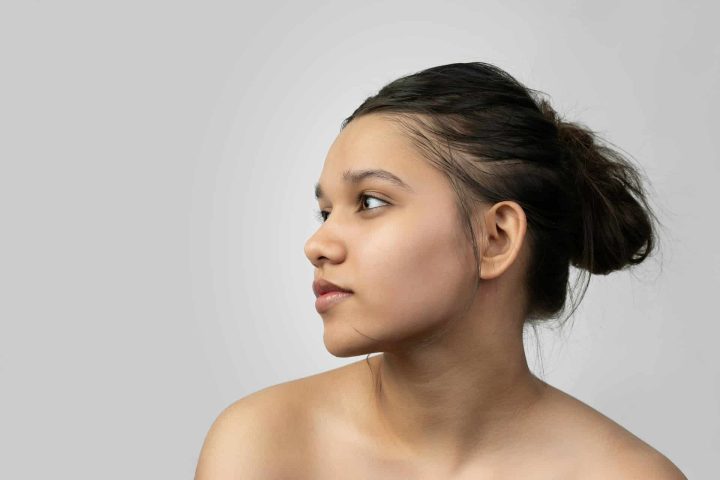 Otoplasty Otoplasty