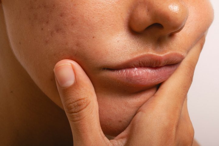 Acne Awareness Month Acne Awareness Month